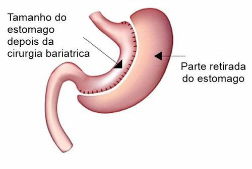 Cirurgia Bari Trica